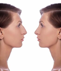 profile female before and after plastic surgery on her nose