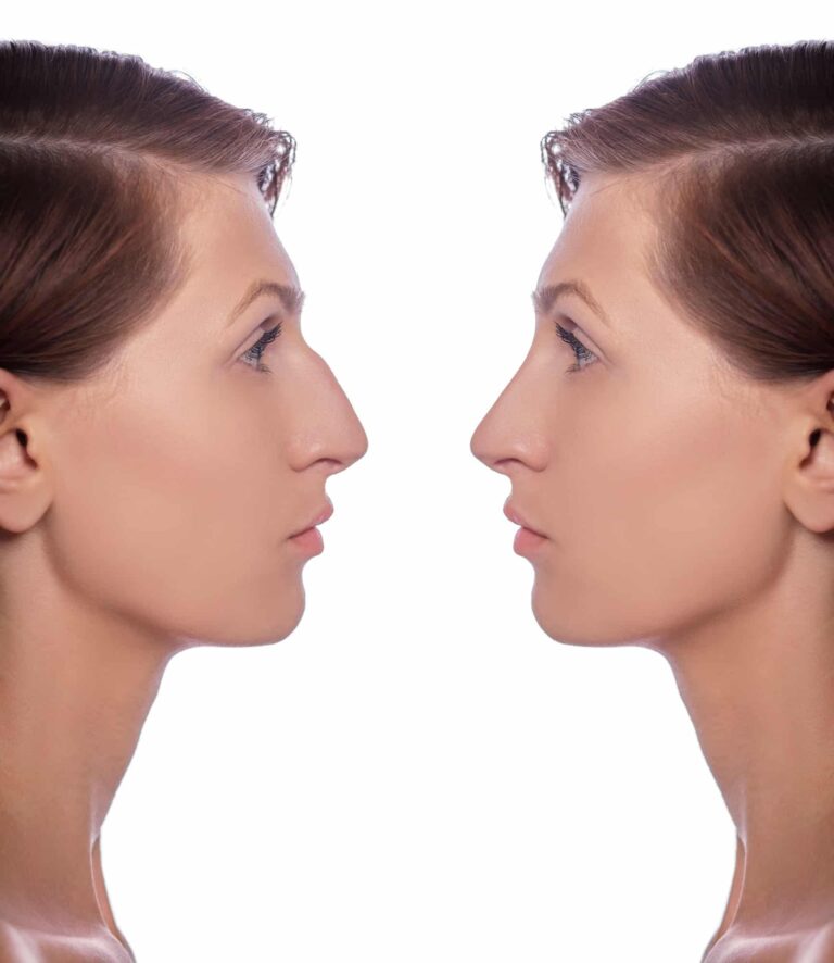 profile female before and after plastic surgery on her nose