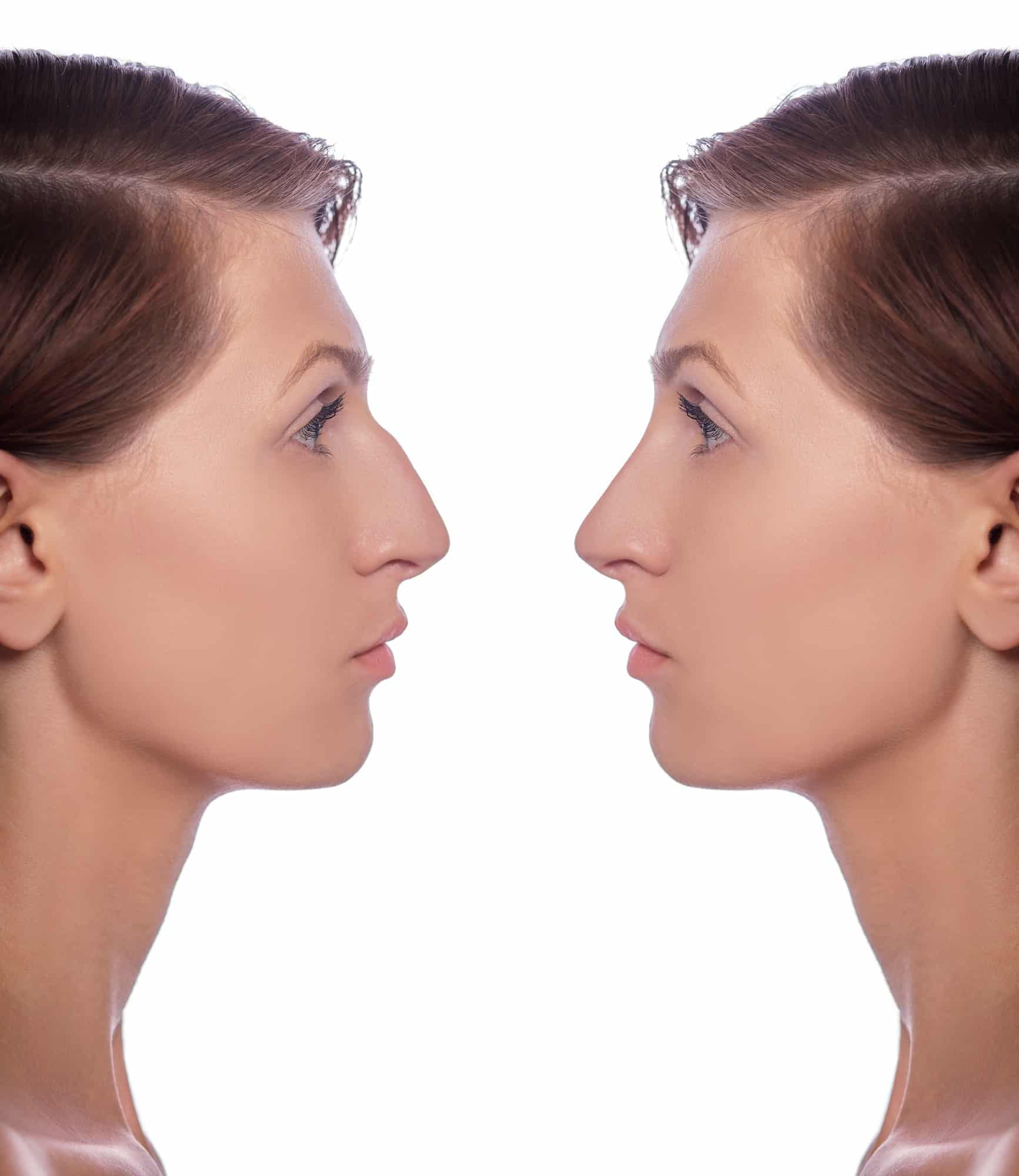 profile female before and after plastic surgery on her nose
