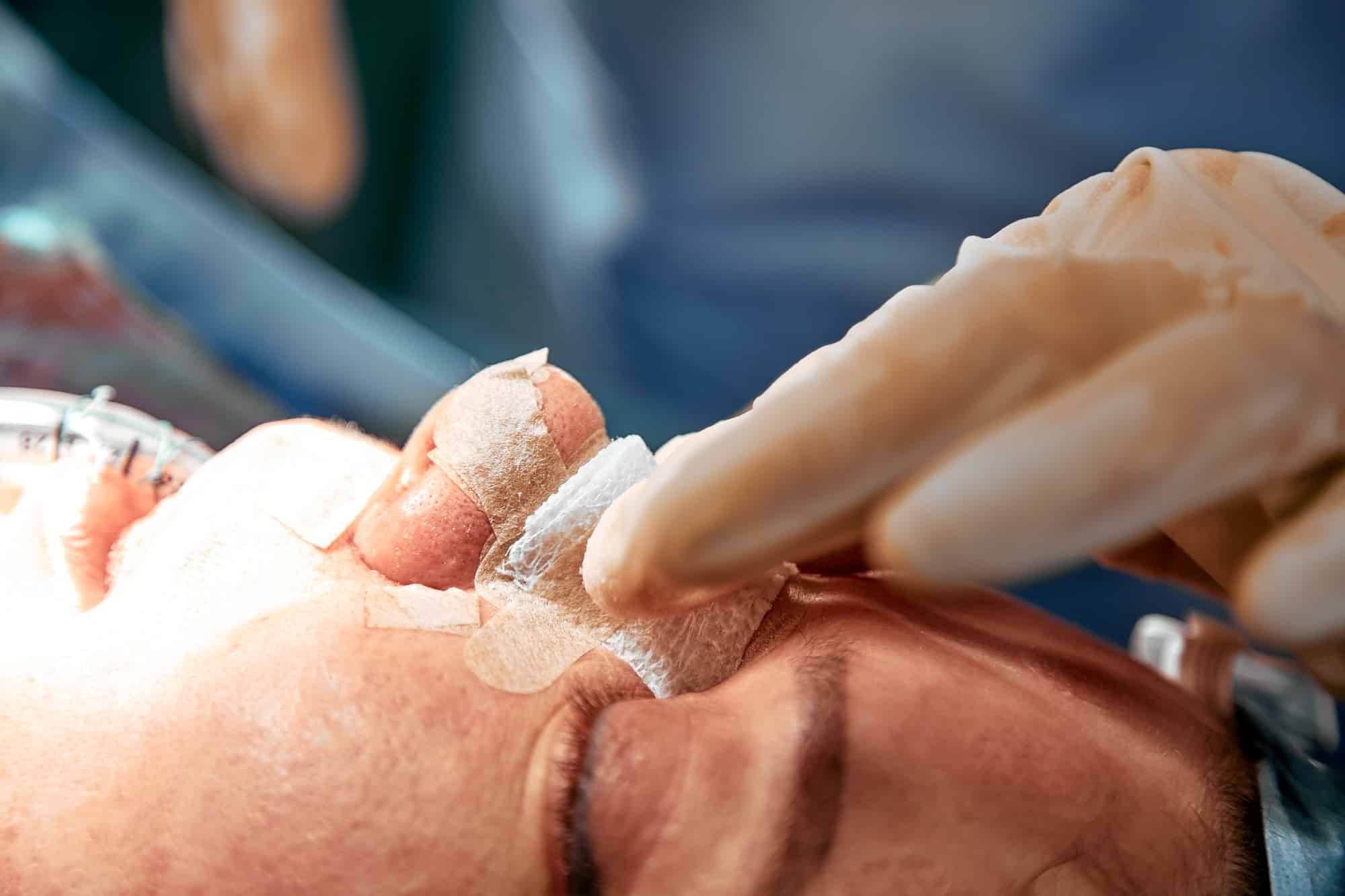 Rhinoplasty close-up. An operating team of several doctors performs nose surgery. Curved septum